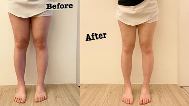 中醫減重 大腿埋線